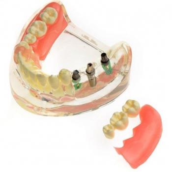 JX®歯科インプラント歯模型M6006