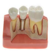 【4月特価商品】JX®歯科インプラント・クラウン歯模型M2017