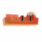 JX®歯科インプラント歯模型M2018