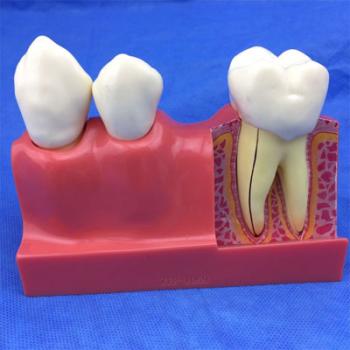   歯模型 口腔模型 4倍大臼歯模型 3分解模型SYM-31
