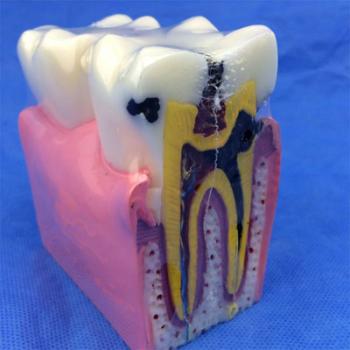 歯模型 口腔模型 大臼歯虫歯模型SYM-32