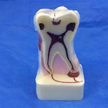  歯模型 口腔模型 4倍歯周病模型SYM-33