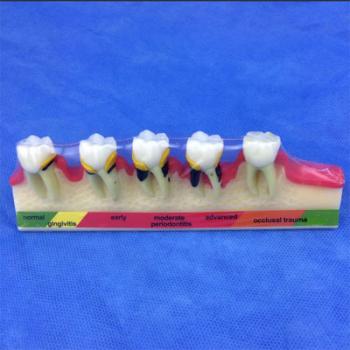 歯模型 口腔模型 歯周疾患分類模型SYM-38