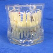 歯列模型 4倍インプラント歯模型 口腔病歯科模型SYM-13