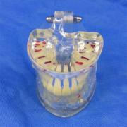 歯列模型 歯模型 口腔模型 透明病理模型SYM-15