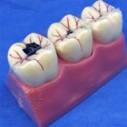  歯模型 口腔模型 4倍大臼歯虫歯模型SYM-29