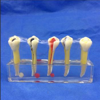  歯模型 口腔模型 歯髄疾患処置説明用模型SYM-30
