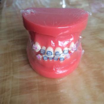 歯列模型 口腔模型 上下歯列矯正模型(セラミックブラケット セラミック矯正) HST-B1－03