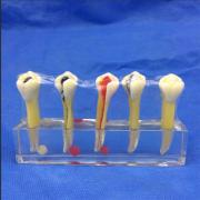  歯模型 口腔模型 歯髄疾患処置説明用模型SYM-30